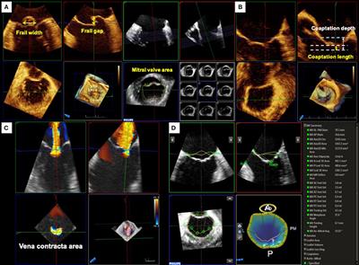 Role of 3D Transesophageal Echocardiography for Transcatheter Mitral Valve Repair—A Mini Review